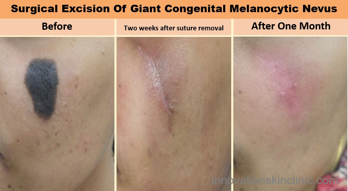 Birth Mark Removal Surgery - Congenital Melanocytic Nevus